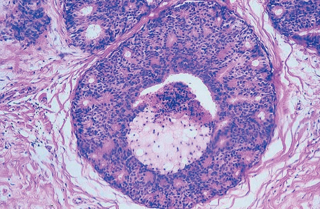 Imagen: Histopatología del cáncer de mama: carcinoma intraductal, tipo comedo, con conducto distendido con una membrana basal intacta y necrosis tumoral central (Fotografía cortesía de Peter Abdelmessieh, DO, MSc).