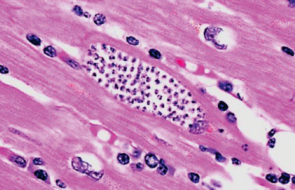 Imagen: Amastigotes de Trypanosoma cruzi en el tejido cardíaco de un paciente con enfermedad de Chagas (Fotografía cortesía del CDC).