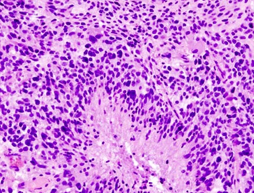 Imagen: Una fotomicrografía que muestra la imagen histopatológica del glioblastoma cerebral (Fotografía cortesía de Wikimedia Commons).