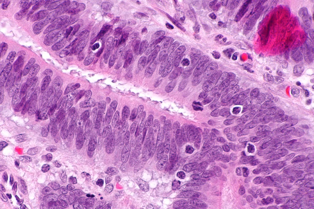 Imagen: Micrografía que muestra linfocitos infiltrantes de tumores en el carcinoma colorrectal. Coloración con H y E. Los linfocitos infiltrantes de tumores (LIT) sugieren inestabilidad de los microsatélites (MSI) (Fotografía cortesía de Wikimedia).