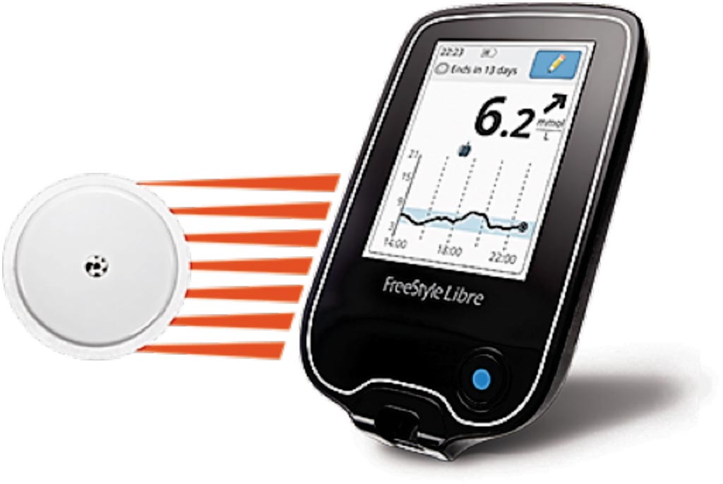 Imagen: El sistema de monitorización de glucosa FreeStyle Libre Flash (Fotografía cortesía de Abbott).