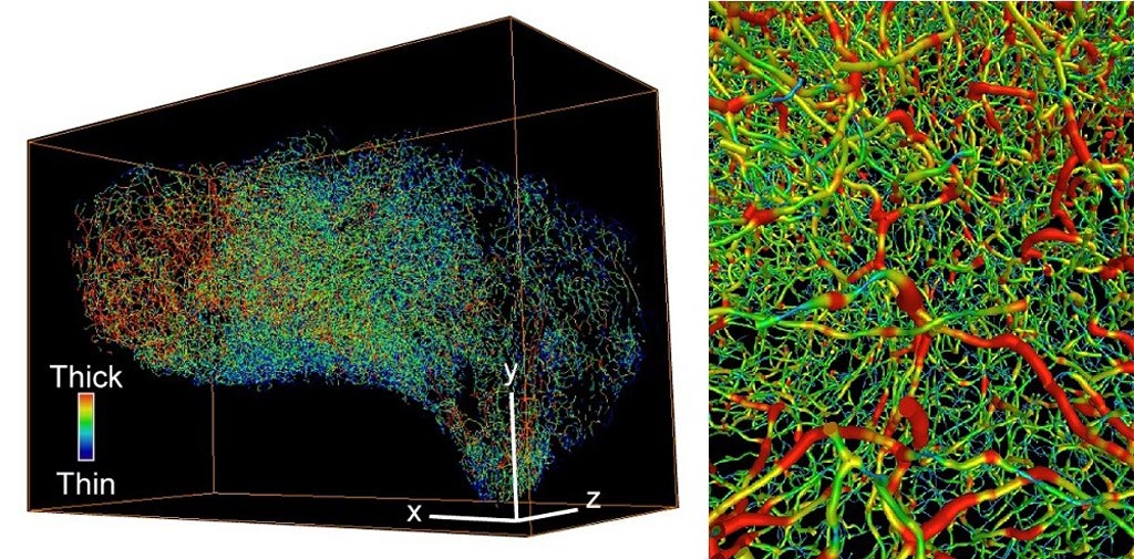 Imagen: Imágenes tridimensionales que muestran el sistema vascular complejo en el cáncer de ovario (izquierda) y en el cáncer de vejiga (derecha). Los vasos gruesos son de color rojo, los vasos finos de color azul (Fotografía cortesía de Nobuyuki Tanaka/Instituto Karolinska).
