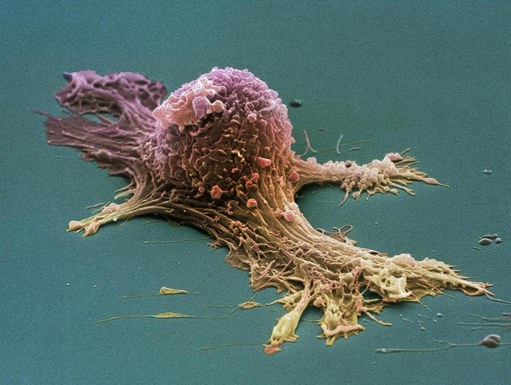 Imagen: Una microfotografía electrónica de barrido (SEM) de una célula de cáncer de ovario (Fotografía cortesía de Steve Gschmeissner / SPL).