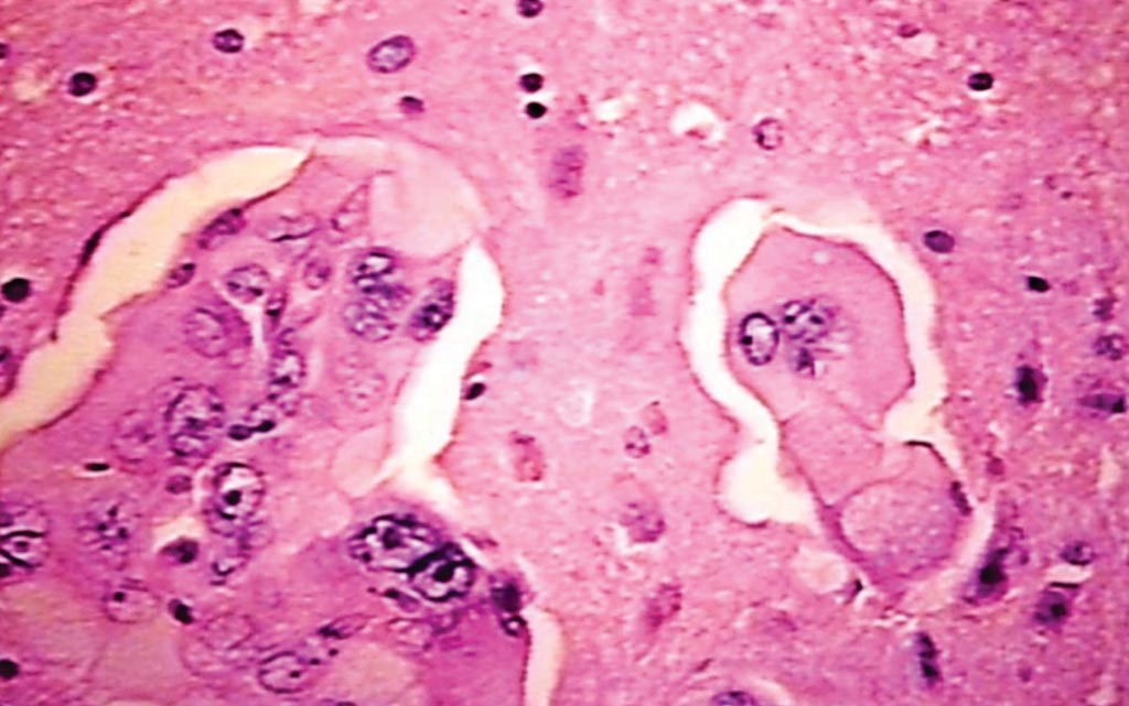 Imagen: una histopatología de un cerebro que muestra lesiones metastásicas de un paciente con cáncer de pulmón no microcítico (Fotografía cortesía de Peter Anderson).
