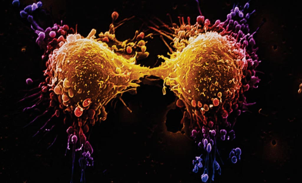 prueba de puntaje de cáncer de próstata