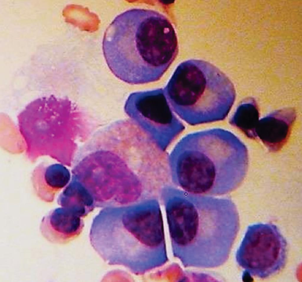Imagen: Una biopsia de médula ósea que muestra células plasmáticas de un paciente con mieloma múltiple (Fotografía cortesía de la Sociedad Estadounidense de Oncología Clínica).