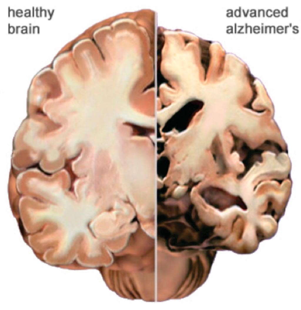 Imagen: Un corte transversal de un cerebro sano comparado con un cerebro de un paciente con enfermedad de Alzheimer (Fotografía cortesía de la Asociación de Alzheimer).