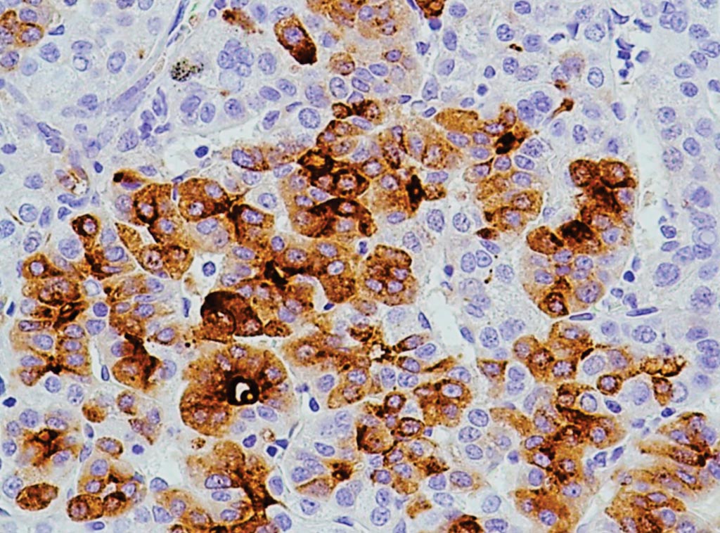 Imagen: Inmunohistoquímica del anticuerpo anti-alfa-fetoproteína (AFP) en el tejido hepático de un paciente con carcinoma hepatocelular (Fotografía cortesía de Arigo Biolaboratories).