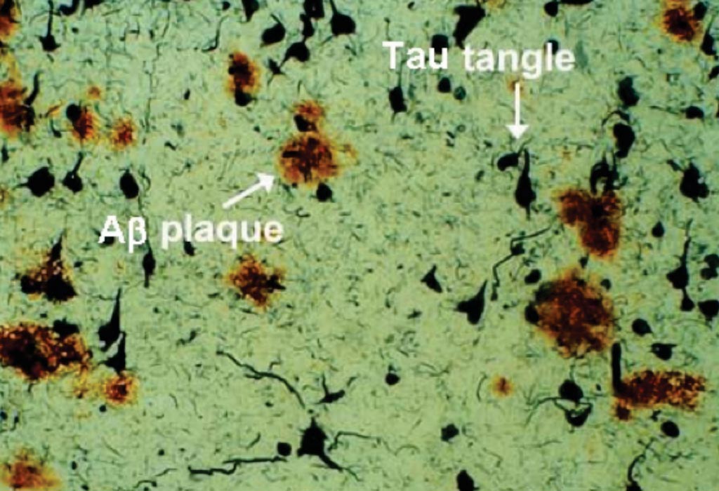 Imagen: La muestra de tejido postmortem del cerebro de un paciente con la enfermedad de Alzheimer (EA) revela una patología que incluye placas de beta amiloide y ovillos de Tau (Fotografía cortesía del Dr. Dale Bredesen).