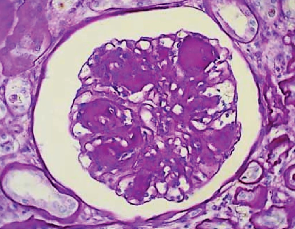 Imagen: Una histopatología de un riñón diabético que muestra el engrosamiento de la membrana basal y la matriz mesangial con esclerosis glomerular nodular y esclerosis intercapilar (Fotografía cortesía de la Universidad de Antioquia).