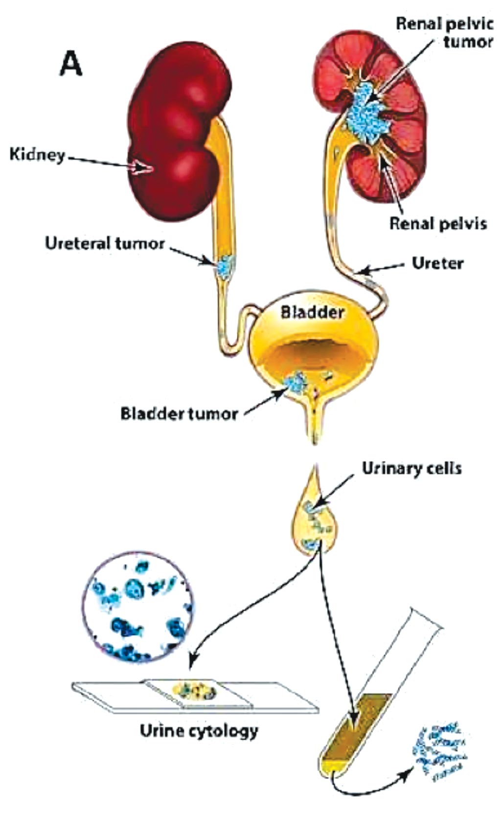Imagen: Un diagrama del método utilizado para evaluar las células urinarias; El diseño del ensayo UroSEEK permite detectar neoplasias uroteliales que están en contacto directo con la orina (Fotografía cortesía de Johns Hopkins Medicine).