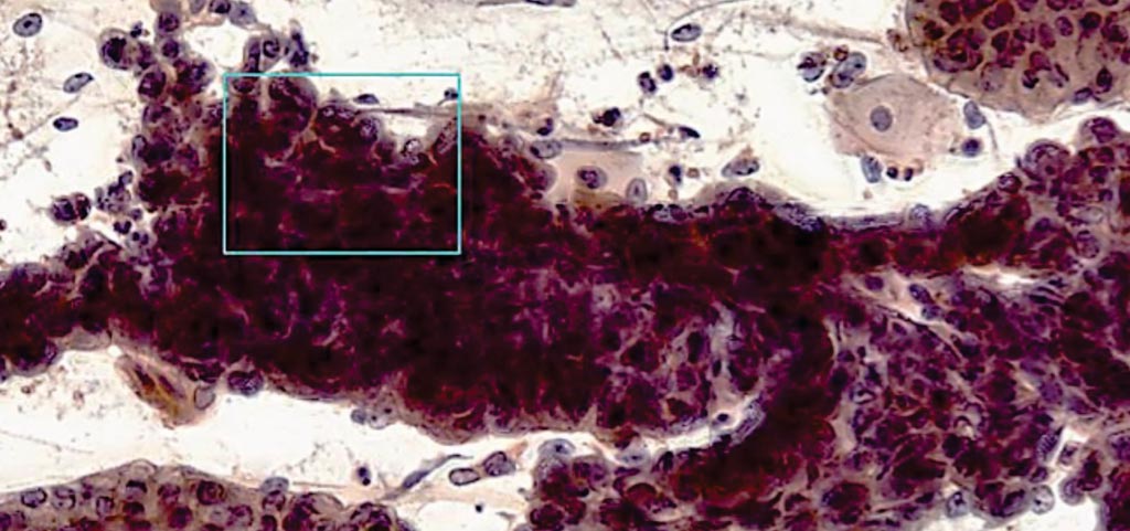 Imagen: El uso de la biopsia WATS3D, un complemento de la biopsia por fórceps identificó a un paciente con anomalías en el esófago (Fotografía cortesía de CDx Diagnostics).