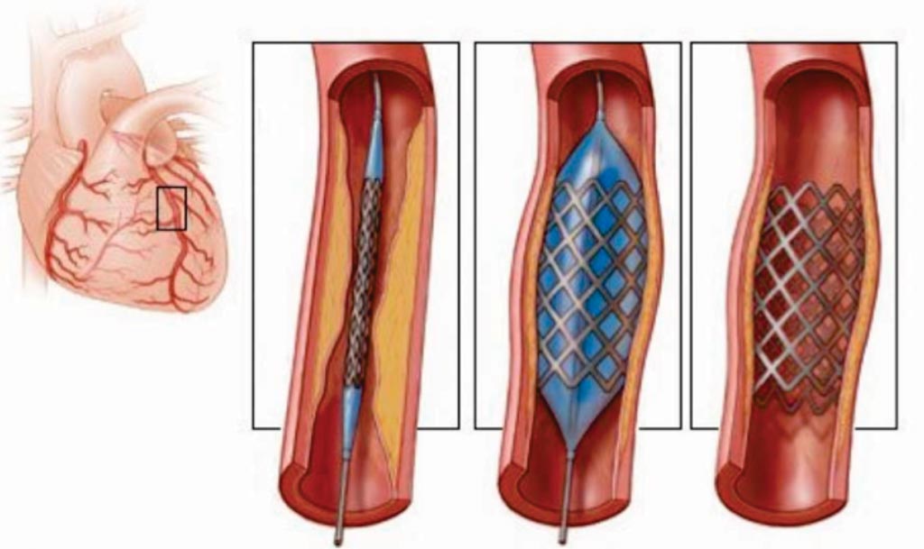 Imagen: Un diagrama de los diferentes stents utilizados en la angioplastia (Fotografía cortesía de Open Biomedical Initiative).