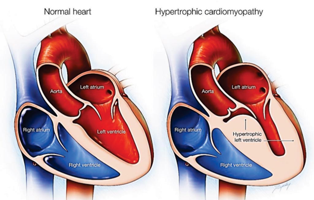 Imagen: Diagrama de un corazón normal en comparación con uno con miocardiopatía hipertrófica (Fotografía cortesía de la Clínica Mayo).