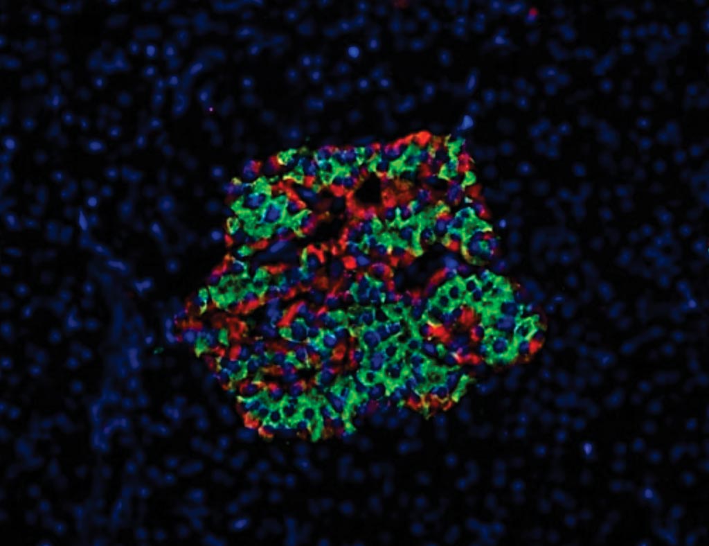 Imagen: Islote de Langerhans del páncreas de un paciente con diabetes crónica de tipo 1 de 19 años de duración. Se descubrió que un solo lóbulo del páncreas contenía islotes ricos en células beta residuales (células alfa en rojo, células beta en verde) (Fotografía cortesía de Diapedia).