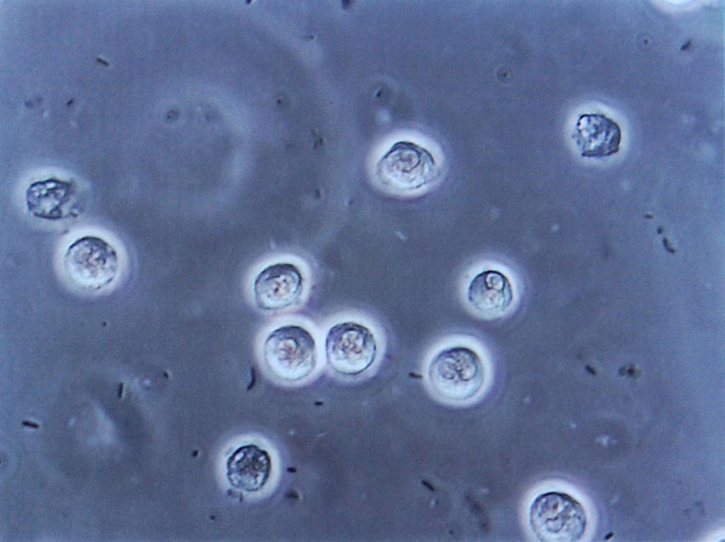 Imagen: Múltiples bacilos (bacterias en forma de bastones, que se muestran aquí como negros y en forma de frijol) se ven entre los glóbulos blancos en la microscopía urinaria. Estos cambios son indicativos de una infección del tracto urinario (Fotografía cortesía de Wikimedia Commons).