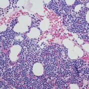 Imagen: El mieloma múltiple, un cáncer del plasma sanguíneo (Fotografía cortesía de Medical News Today).