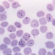 Imagen: Una fotomicrografía de un frotis de sangre delgado coloreado con Giemsa que revela la presencia de numerosos trofozoitos anulares de Plasmodium falciparum, con algunos glóbulos rojos (RBC) infectados que albergan múltiples organismos (Fotografía cortesía de CDC/Steven Glenn) .
