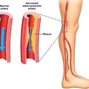 Imagen: Diagrama de la enfermedad arterial periférica; los vasos sanguíneos de las piernas son los que se ven afectados con más frecuencia (Fotografía cortesía de la Clínica de Manejo del Dolor Emed Pain).