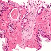 Imagen: Fotomicrografía de una biopsia de próstata de adenocarcinoma de próstata, tipo convencional (acinar), la forma más común de cáncer de próstata (Fotografía cortesía de Nephron).