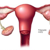 Imagen: Un diagrama que muestra un ovario normal y otro con síndrome de ovario poliquístico; en este último los ovarios pueden desarrollar numerosas colecciones pequeñas de líquido (folículos) y no pueden liberar los óvulos regularmente (Fotografía cortesía de la Clínica Mayo).