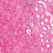 Imagen: Microfotografía de gran aumento de un oncocitoma renal. Las células tumorales (a la izquierda de la imagen) están dispuestas en nidos, tienen núcleos ligeramente agrandados y tienen un citoplasma más eosinofílico (rosa oscuro) que las células del riñón normal-túbulos renales (derecha de la imagen) (Fotografía cortesía de Nephron).