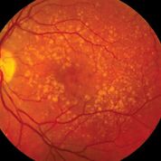 Imagen: Una foto de fondo de ojo que muestra una degeneración macular intermedia relacionada con la edad (Fotografía cortesía del Instituto Nacional Ocular).