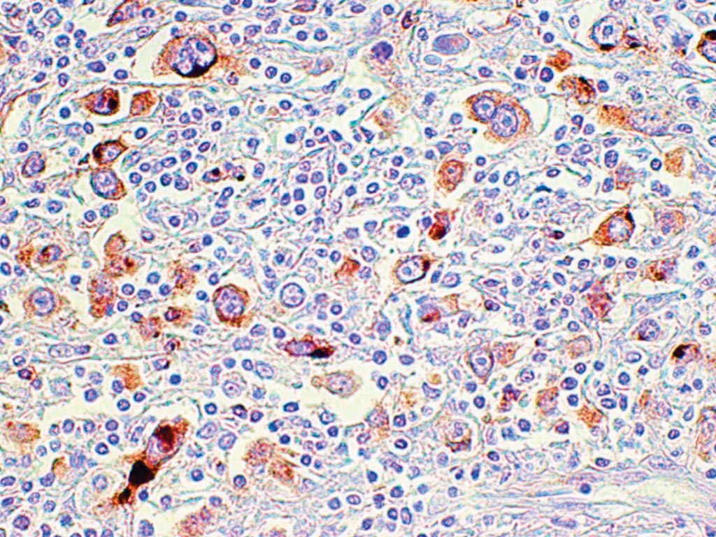 Imagen: Coloración inmunohistoquímica para CD137 realizada en cortes de tejido incluidos en parafina (citoplásmicos y membranosos) utilizando el clon monoclonal BBK-2 (aumento original × 400) (Fotografía cortesía de Peter N. Carbone, MD y Qian-Yun Zhang, MD, PhD).