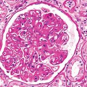 Imagen: Fotomicrografía de un glomérulo con cambios característicos de una glomerulopatía por trasplante. La glomerulopatía por trasplante se considera una forma de rechazo crónico mediado por anticuerpos (Fotografía cortesía de Nephron).