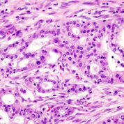 Imagen: Una fotomicrografía de adenocarcinoma ductal pancreático (el tipo más común de cáncer pancreático) (Fotografía cortesía de Wikimedia Commons).
