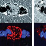 Imagen: Fotomicrografías de tejidos de pacientes con mioglobinopatía, una nueva enfermedad muscular causada por una mutación en el gen de la mioglobina (Fotografía cortesía del Instituto de Investigación Biomédica Bellvitge).