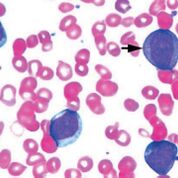 Imagen: Frotis de sangre de un paciente con leucemia mieloide aguda definida por la presencia de más de 90% de mieloblastos en sangre y/o médula ósea (Fotografía cortesía de Pathpedia).