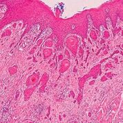 Imagen: Una histopatología del cáncer oral: se pueden ver islas de tumores que se infiltran en los tejidos conectivos en las profundidades del epitelio oral suprayacente. Este carcinoma es moderadamente diferenciado con un patrón invasivo no cohesivo (Fotografía cortesía de la Universidad de Sheffield).