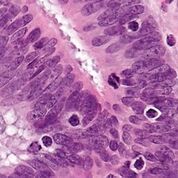 Imagen: Una microfotografía que muestra linfocitos infiltrantes de tumores en un caso de cáncer colorrectal con evidencia de alta inestabilidad de los microsatélites (MSI-H) en la inmunocoloración (Fotografía cortesía de Nephron).