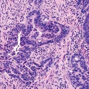 Imagen: Una histopatología del carcinoma colorrectal: un ejemplo de adenocarcinoma moderadamente diferenciado que muestra estructuras glandulares complicadas en un estroma desmoplásico (Fotografía cortesía de la Facultad de Medicina David Geffen de la Universidad de California).