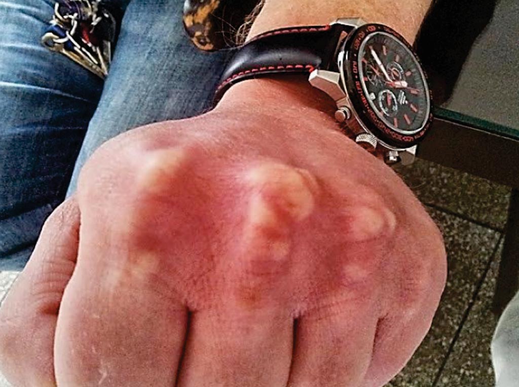 Imagen: Xantomas tendinosos en la mano de un paciente con hipercolesterolemia familiar (Fotografía cortesía de ScreenPro FH).