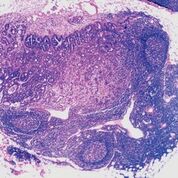 Imagen: Una histopatología de ganglios linfáticos con adenocarcinoma metastásico del colon (Fotografía cortesía del Dr. Ed Uthman M.D).