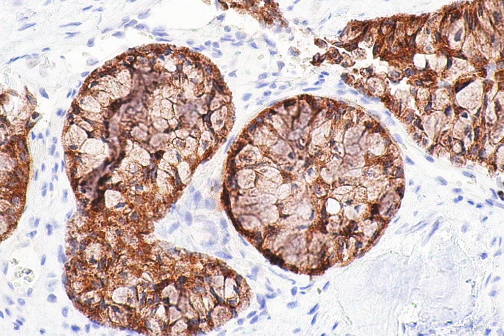 Una micrografía que muestra un adenocarcinoma de pulmón (Fotografía cortesía de Wikimedia Commons).
