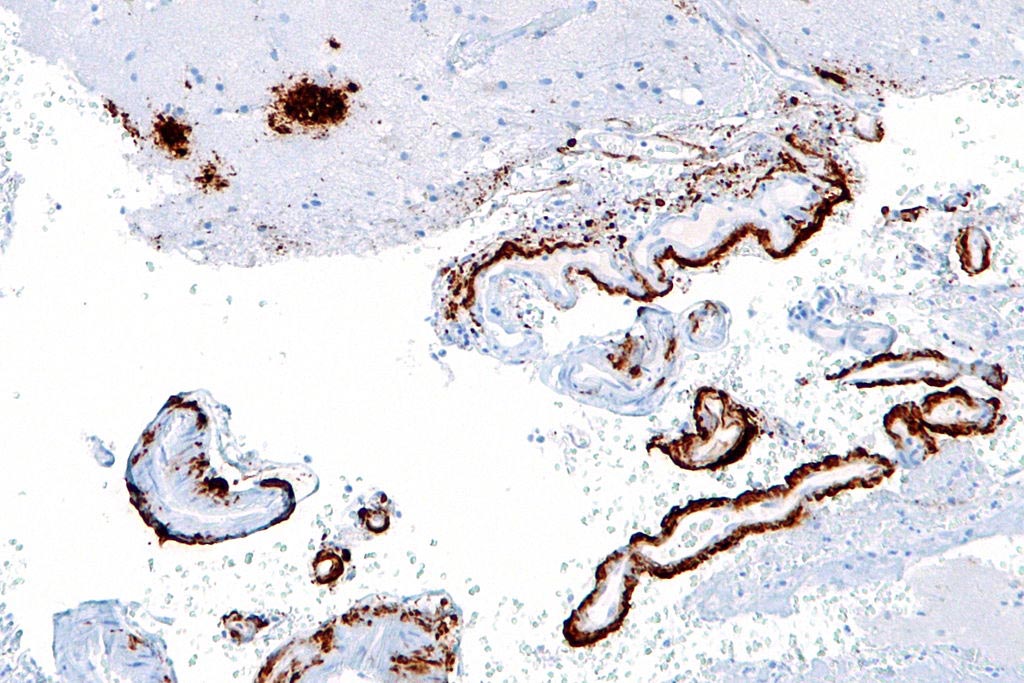 Una microfotografía que muestra beta amiloide (marrón) en placas seniles de la corteza cerebral (parte superior izquierda de la imagen) y vasos sanguíneos cerebrales (derecha de la imagen) usando una inmunocoloración (Fotografía cortesía de Wikimedia Commons).