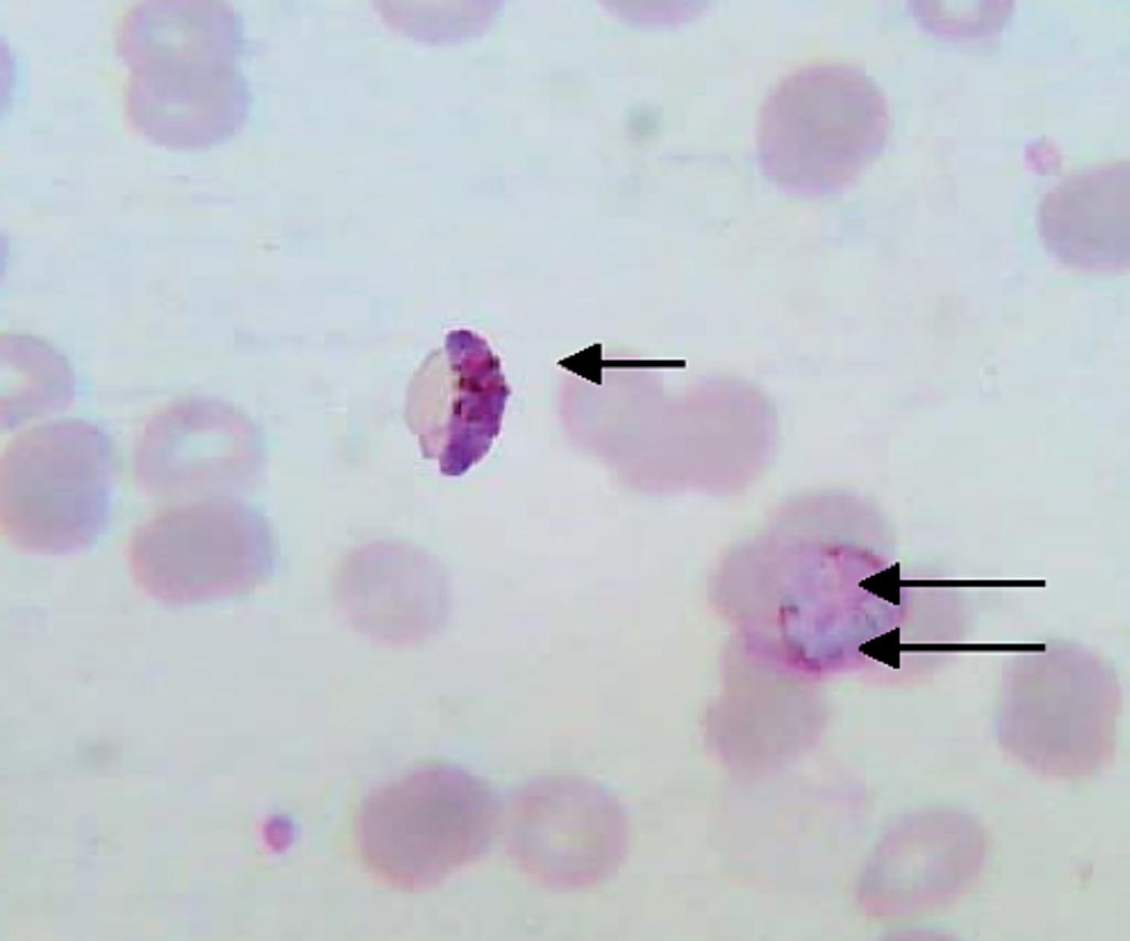 Imagen: Frotis de sangre delgado mostrando un gametocito de Plasmodium falciparum (flecha única) y un esquizonte de P. vivax (flecha doble) de un caso de infección mixta (Fotografía cortesía de Sulekha Bhat et al).