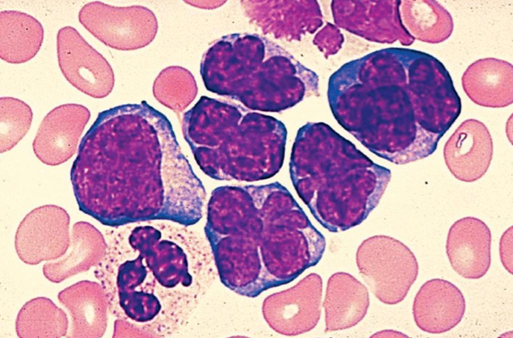 Un frotis de sangre de un paciente con linfoma no Hodgkin que muestra linfocitos muy grandes (Fotografía cortesía de Venngage).