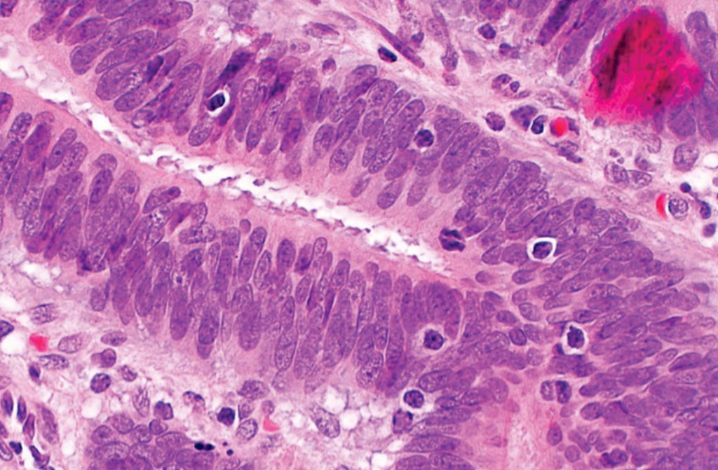 Una microfotografía que muestra linfocitos infiltrantes de tumores en el carcinoma colorrectal, sugestivos de inestabilidad de los microsatélites, y que se pueden ver en el síndrome de Lynch (Fotografía cortesía de Nephron).