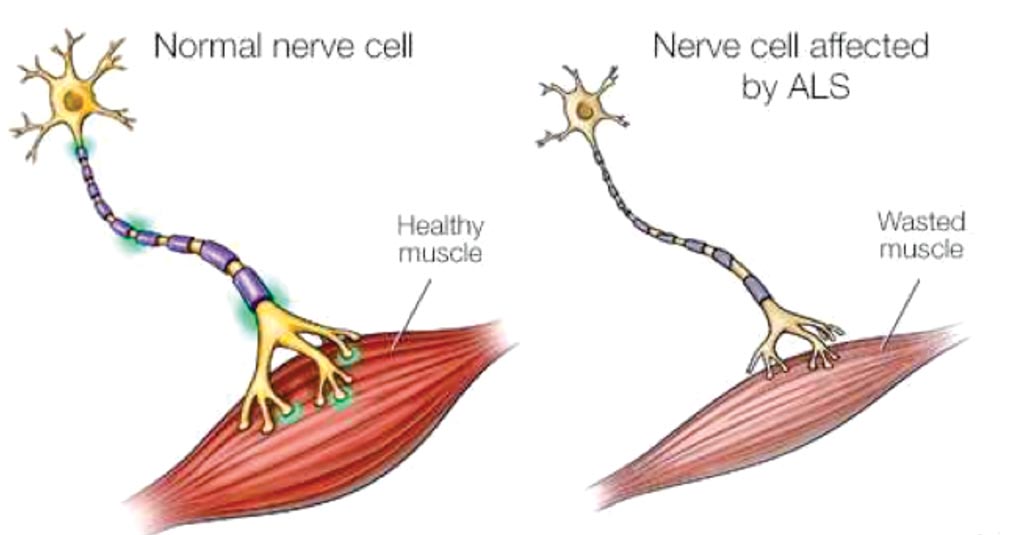 Diagrama de una célula normal y de una célula nerviosa afectada por esclerosis lateral amiotrófica (Fotografía cortesía de Mayo Clinic).