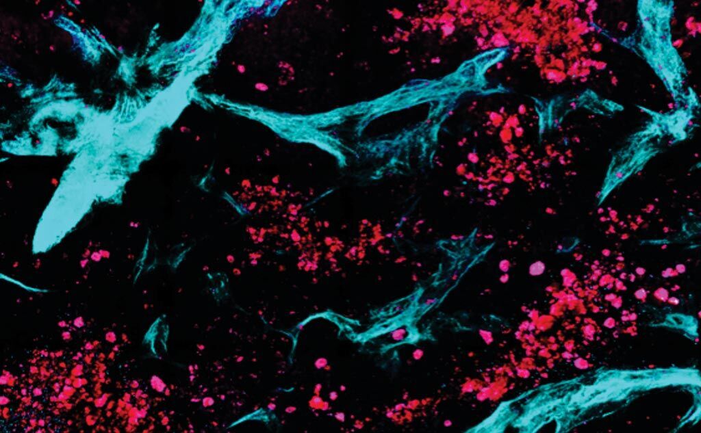 Imagen: Los científicos combinaron la microscopía multifotónica con algoritmos automáticos de análisis de imágenes y estadísticas para diferenciar entre el tejido sano y el enfermo. En esta imagen, recopilada de una manera no invasiva, completamente libre de etiquetas, el colágeno se colorea de verde mientras que los grupos de células metastásicas ováricas se presentan en rojo (Fotografía cortesía de la Universidad de Tufts).