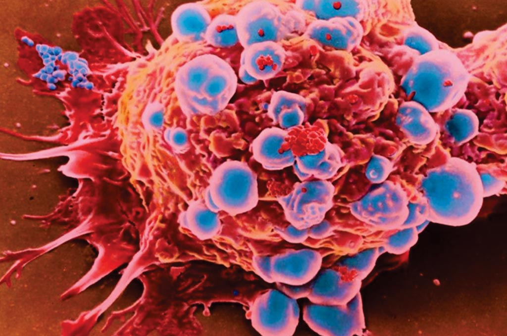 Imagen: Microfotografía electrónica de barrido (SEM) de células de cáncer de mama. Las pruebas para varios genes de alto riesgo, no seleccionadas, para todas las pacientes con cáncer de mama, son extremadamente rentables (Fotografía cortesía de Marie Thibault).