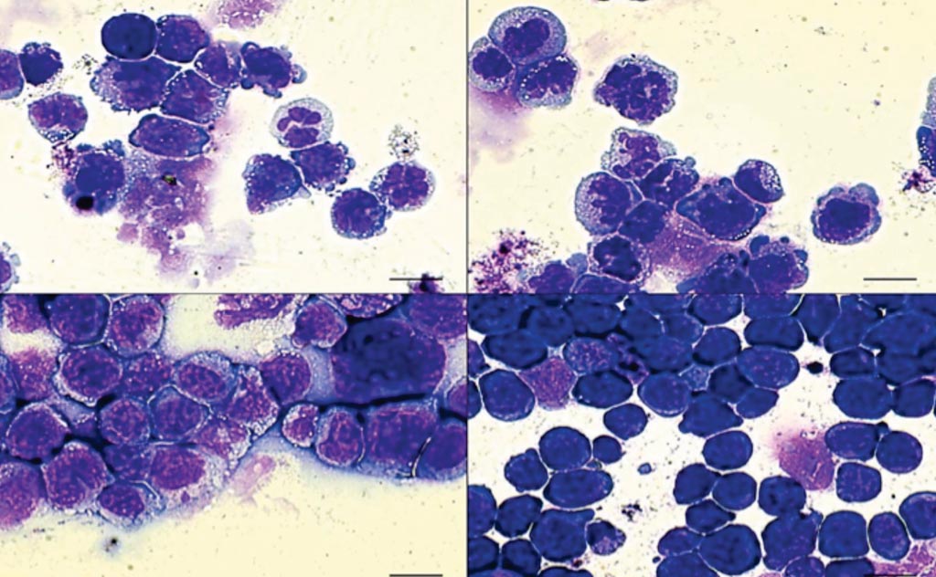 Imagen: En la leucemia mieloide aguda (LMA), hay células sanguíneas defectuosas (de color púrpura). Cuando las células tienen una doble mutación de los genes IDH2 y SRSF2 (abajo a la derecha), el número de células defectuosas aumenta considerablemente, indicando una enfermedad más letal (Fotografía cortesía del Laboratorio Cold Spring Harbor).