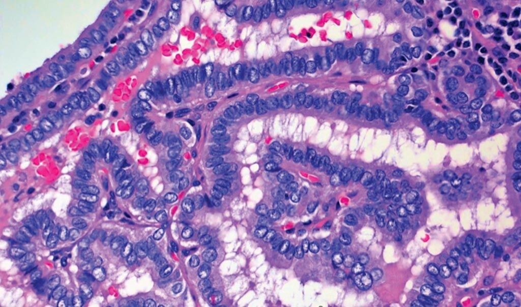 Imagen: Una imagen de microscopio de células de cáncer de tiroides, específicamente de carcinoma papilar de tiroides o CPT (Fotografía cortesía de Wendong Yu/Facultad de Medicina Baylor).
