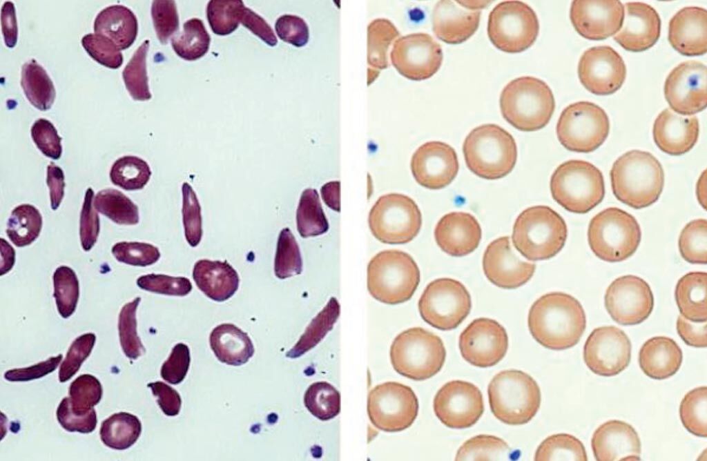 Imagen: Sangre extraída de un paciente con células falciformes (izquierda) y de un paciente después del trasplante de células madre (derecha) (Fotografía cortesía de la Rama de Hematología Clínica y Molecular de los NIH).