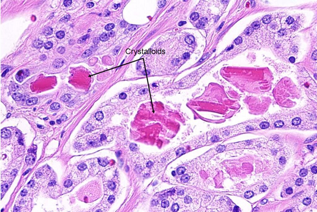 Imagen: Histopatología del cáncer de próstata: cristaloides (estructuras romboides a prismáticas eosinófilas brillantes, que se pueden observar en ~ 40% de los casos de cáncer) y secreciones eosinofílicas amorfas (Fotografía cortesía de la Asociación Americana de Urología).
