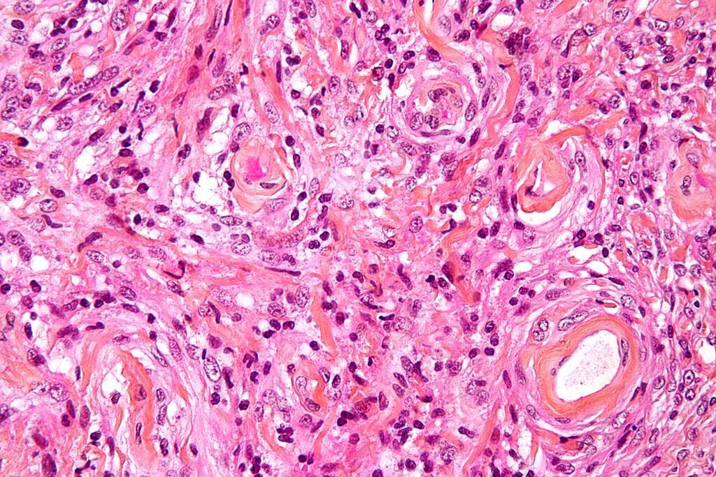 Imagen: Microfotografía de gran aumento de un meningioma que muestra los remolinos característicos (Fotografía cortesía de Wikimedia Commons).